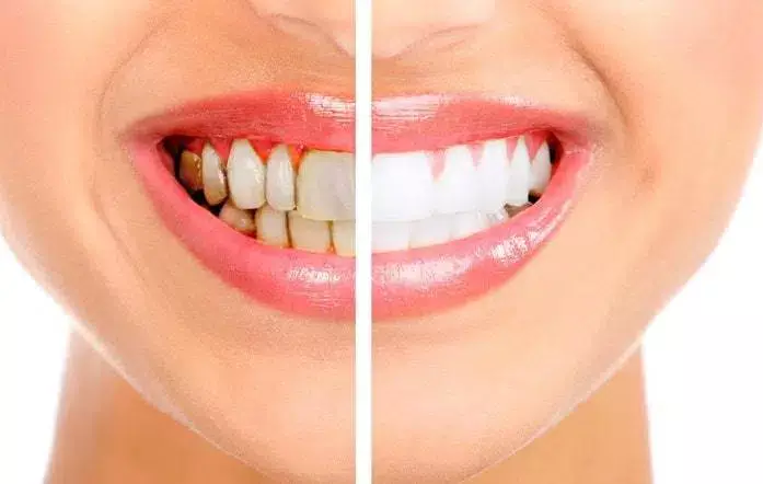 Best Teeth Whitening in Pimple Saudagar Best Teeth Whitening in Pimple Saudagar<br />