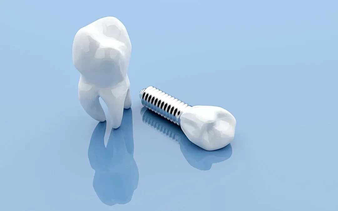 Are Dental Implants Best for Missing Teeth?