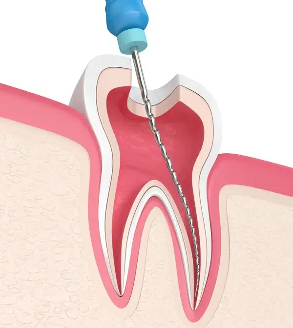 Root Canal Treatment in Pimple Saudagar Best Root Canal Treatment in Pimple Saudagar