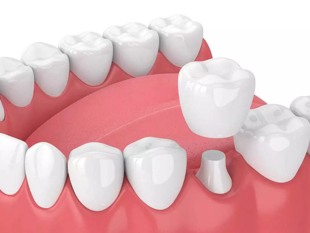 Dental Crowns and Bridges for Teeth Dental Crowns and Bridges for Teeth
