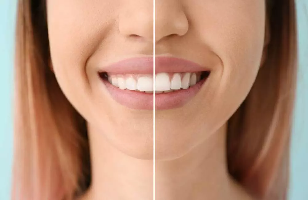 How to Get Perfect Teeth Like Celebrities?