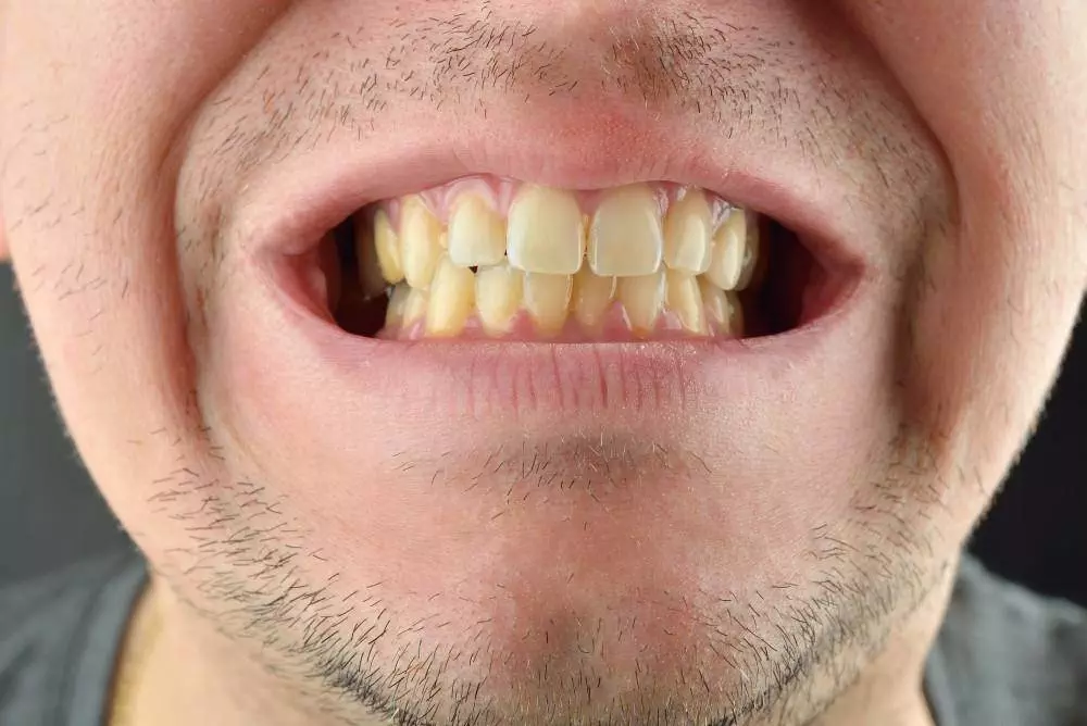 Having white, bright teeth is often associated with good health and an attractive smile. However, many people struggle with yellowing teeth due to various factors such as age, diet, and poor oral hygiene. The good news is that yellow teeth can become white! There are several ways to whiten your teeth, both professionally and at home. In this article, we’ll explore the causes of yellow teeth and the most effective methods for whitening them. What Causes Yellow Teeth? Teeth can become yellow for a variety of reasons, some of which are preventable, while others are more difficult to avoid. Understanding the causes of yellow teeth is the first step in finding an appropriate solution. 1. Poor Oral Hygiene Plaque and tartar build-up: Not brushing and flossing regularly can lead to plaque accumulation on your teeth, which can make them appear yellow. Lack of cleaning after meals: When food particles and drinks are left on the teeth, they can stain the enamel, leading to yellowing. 2. Diet and Food Choices Foods and drinks that stain: Coffee, tea, red wine, curry, and berries are known to stain teeth over time due to their strong color pigments. Acidic foods and drinks: Citrus fruits, soda, and other acidic substances can erode enamel, making teeth appear more yellow. 3. Smoking and Tobacco Use Tobacco stains: Smoking or chewing tobacco can lead to stubborn yellow or brown stains on your teeth that are difficult to remove. 4. Aging Enamel thinning: As you age, the enamel on your teeth naturally wears down, revealing the yellowish dentin underneath. Wear and tear: Years of chewing, biting, and exposure to food and drink can cause enamel to erode. 5. Genetics Natural tooth color: Some people naturally have teeth that are more yellow or off-white due to the color of their dentin. 6. Certain Medications Antibiotics: Some antibiotics, like tetracycline, can cause yellowing or staining of the teeth, especially in children whose teeth are still developing. Medications for high blood pressure and asthma: Certain medications can also cause discoloration as a side effect. Effective Ways to Whiten Yellow Teeth 1. Professional Teeth Whitening If you want immediate, dramatic results, professional teeth whitening from a dentist is the most effective option. In-office whitening: Dentists use a stronger concentration of bleaching agents like hydrogen peroxide or carbamide peroxide to whiten teeth quickly. The procedure typically takes one hour, and you can see immediate results. Laser whitening: This method involves applying a whitening gel to your teeth and then using a laser to activate the gel, speeding up the whitening process. Pros: Immediate results. Stronger, more effective treatments. Safe, supervised by a dentist. Cons: Expensive compared to other options. Requires a dentist appointment. 2. At-Home Teeth Whitening Kits For those looking for a more affordable alternative to professional treatments, at-home teeth whitening kits are a good option. These kits typically include whitening gel or strips that contain lower concentrations of peroxide. Whitening strips: These are thin, flexible strips coated with a whitening gel. You apply them to your teeth for 20-30 minutes daily for a few weeks. Whitening trays: Custom or over-the-counter trays are filled with a whitening gel and worn over the teeth for a period of time, typically a few hours each day. Whitening toothpaste: While not as effective for significant stains, whitening toothpaste can help remove surface stains over time. Pros: More affordable than professional whitening. Can be done in the comfort of your home. Easy to use. Cons: Results take longer to appear. May cause temporary tooth sensitivity. 3. Natural Remedies for Whitening Teeth While not as effective as professional treatments, some natural methods can help brighten your teeth and reduce mild yellowing. Baking soda and hydrogen peroxide: Mixing a small amount of baking soda with hydrogen peroxide creates a paste that can help remove surface stains. Brush with this mixture 2-3 times a week for mild whitening. Apple cider vinegar: Some people use diluted apple cider vinegar to help whiten teeth. However, it should be used sparingly as it is acidic and can erode enamel if overused. Coconut oil pulling: Swishing coconut oil around your mouth for 10-15 minutes can help remove plaque and reduce yellowing. This practice has limited scientific backing, but some people find it beneficial. Pros: Affordable and natural. Can help with surface stains. Cons: Limited effectiveness for deep stains. Can cause enamel erosion if not used cautiously. 4. Prevention Tips for Maintaining White Teeth Once you've achieved whiter teeth, it's important to maintain them by adopting good habits that prevent further yellowing. Brush regularly: Brush your teeth at least twice a day using fluoride toothpaste. Consider using a whitening toothpaste to prevent surface stains. Floss daily: Flossing removes food particles and plaque between teeth, reducing the risk of staining. Avoid stain-causing foods and drinks: Limit coffee, tea, red wine, and other stain-causing foods. If you do consume them, rinse your mouth with water afterward. Quit smoking: Tobacco is one of the leading causes of yellow and stained teeth. Quitting smoking will not only improve your oral health but also help prevent further discoloration. Drink through a straw: When consuming drinks that stain, such as coffee or soda, use a straw to minimize contact with your teeth.
