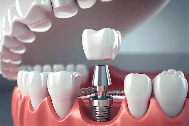 How to Care for Your Dental Implants: Tips