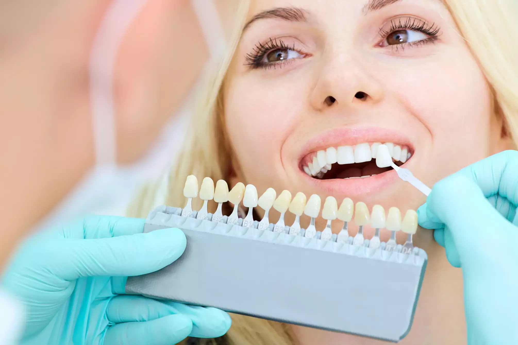 Why Choose Professional Teeth Whitening Over Home Treatments