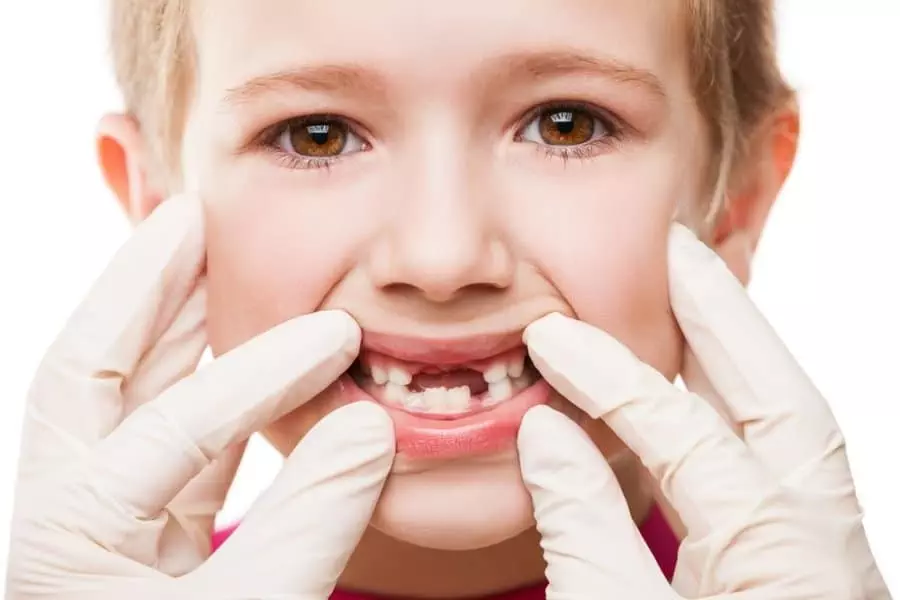 How To Manage and Prevent Tooth Decay in Toddlers
