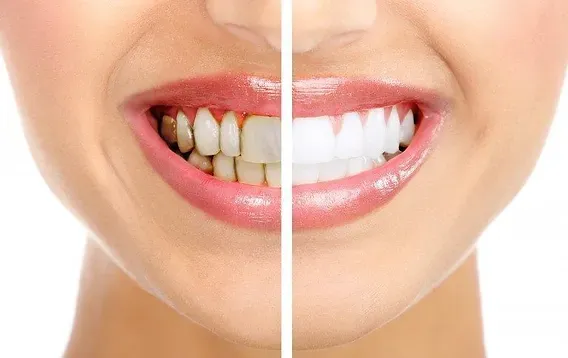 Best Teeth Whitening in Pimple Saudagar