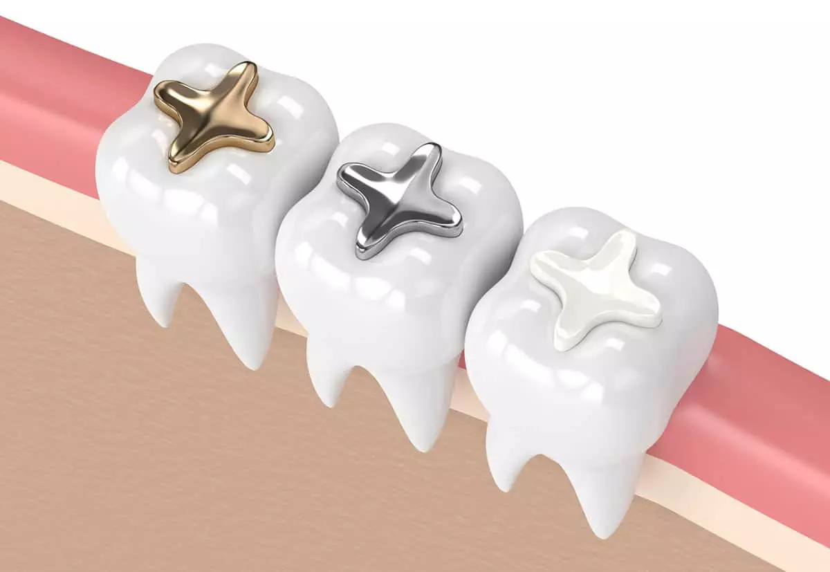 Types of Dental Fillings: Which One Is Right for You?