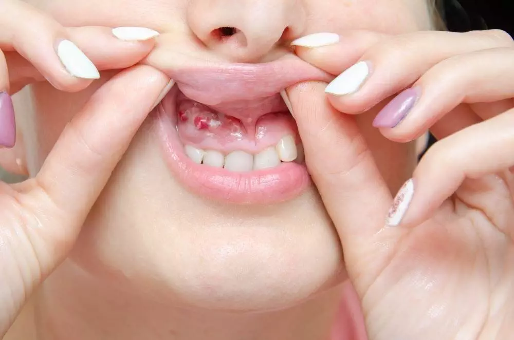 Understanding the Stages of Pyorrhea: A Comprehensive Guide to Dental Health