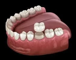 Dental Crowns: Why Do You Need Them?