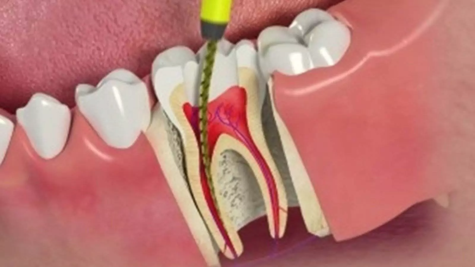Root Canal Misconceptions
