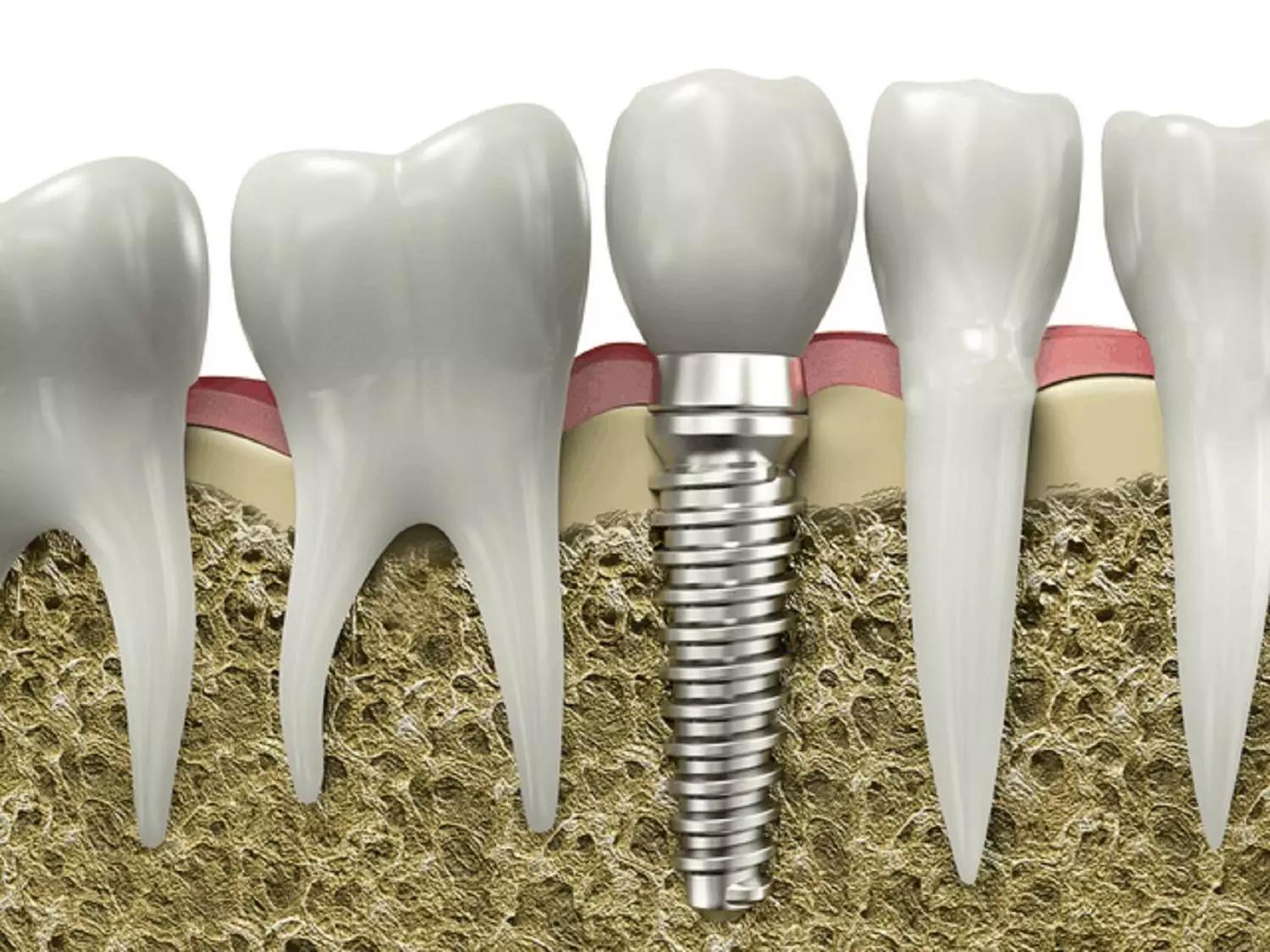 How to Care for Your Dental Implants: Tips