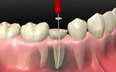 Top 7 Signs You Might Need a Root Canal