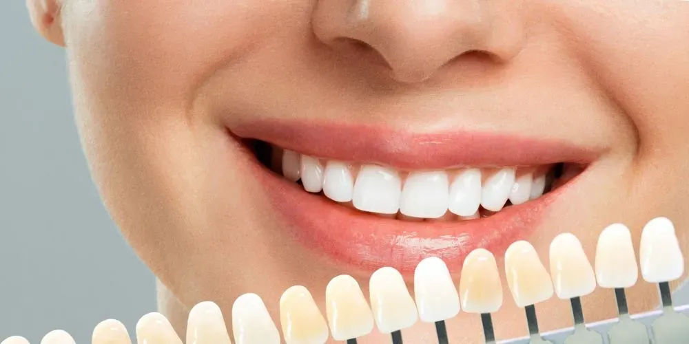 Smile Makeovers in PCMC: How Cosmetic Dentistry Can Transform Your Confidence