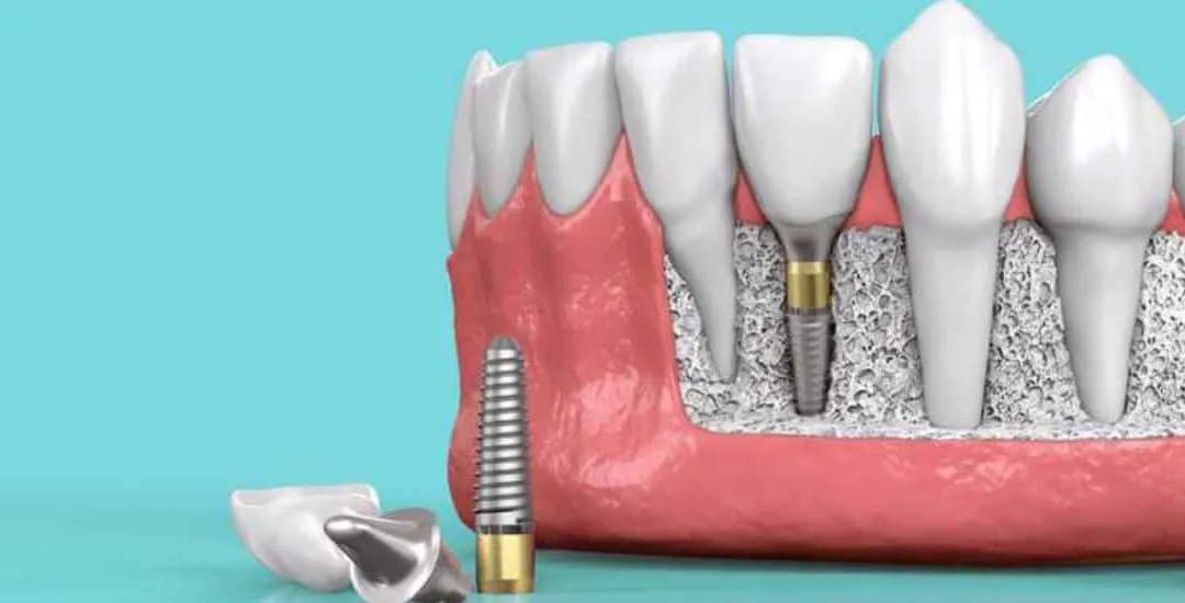 Dental Implants in Wakad: Cost, Procedure & What to Expect