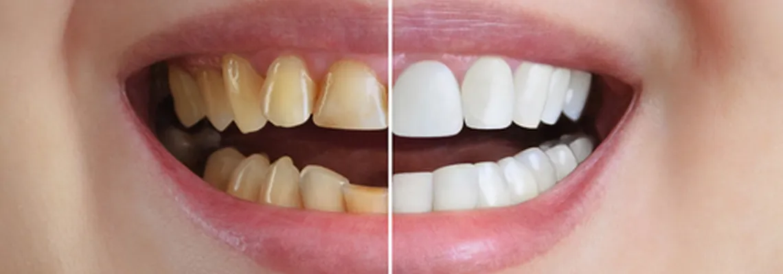 Full Mouth Rehabilitation: What Is It and Who Needs It?