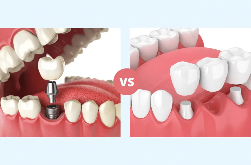 Dental Implants vs. Bridges: Which is Right for You?